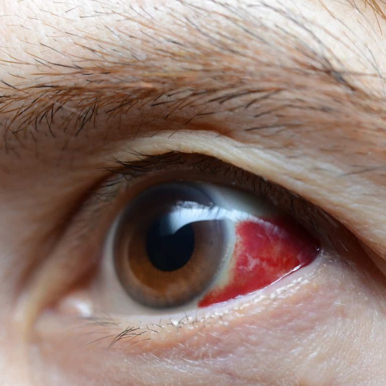 Woman with burst blood vessel in eye, closeup